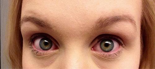 Краснота глаз - один из симптомов аллергии