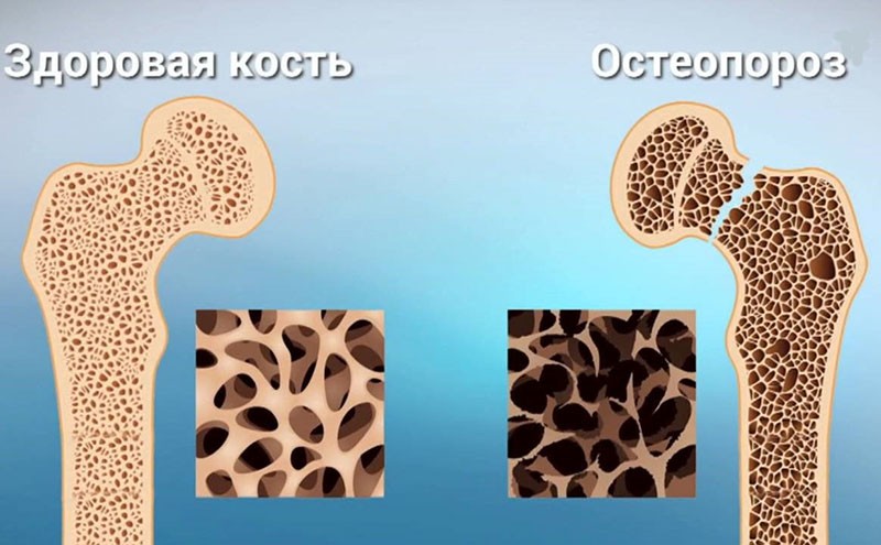 развитие остеопороза